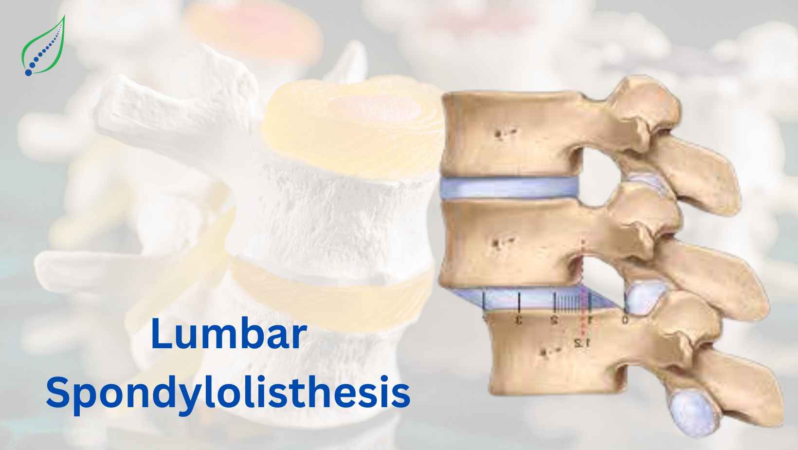 Lumbar Spondylolisthesis